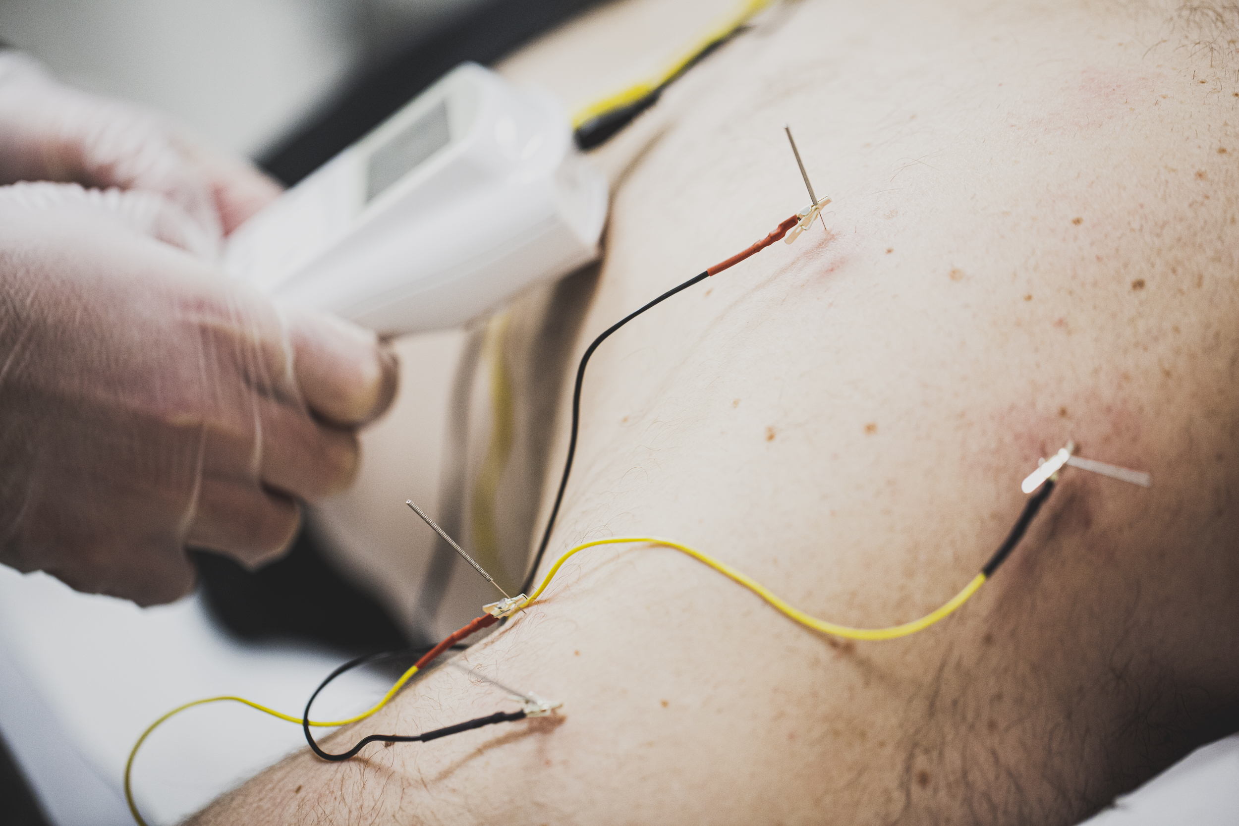 _MG_7195 Neuromodulación en la clínica Ayensa fisioterapia Zaragoza