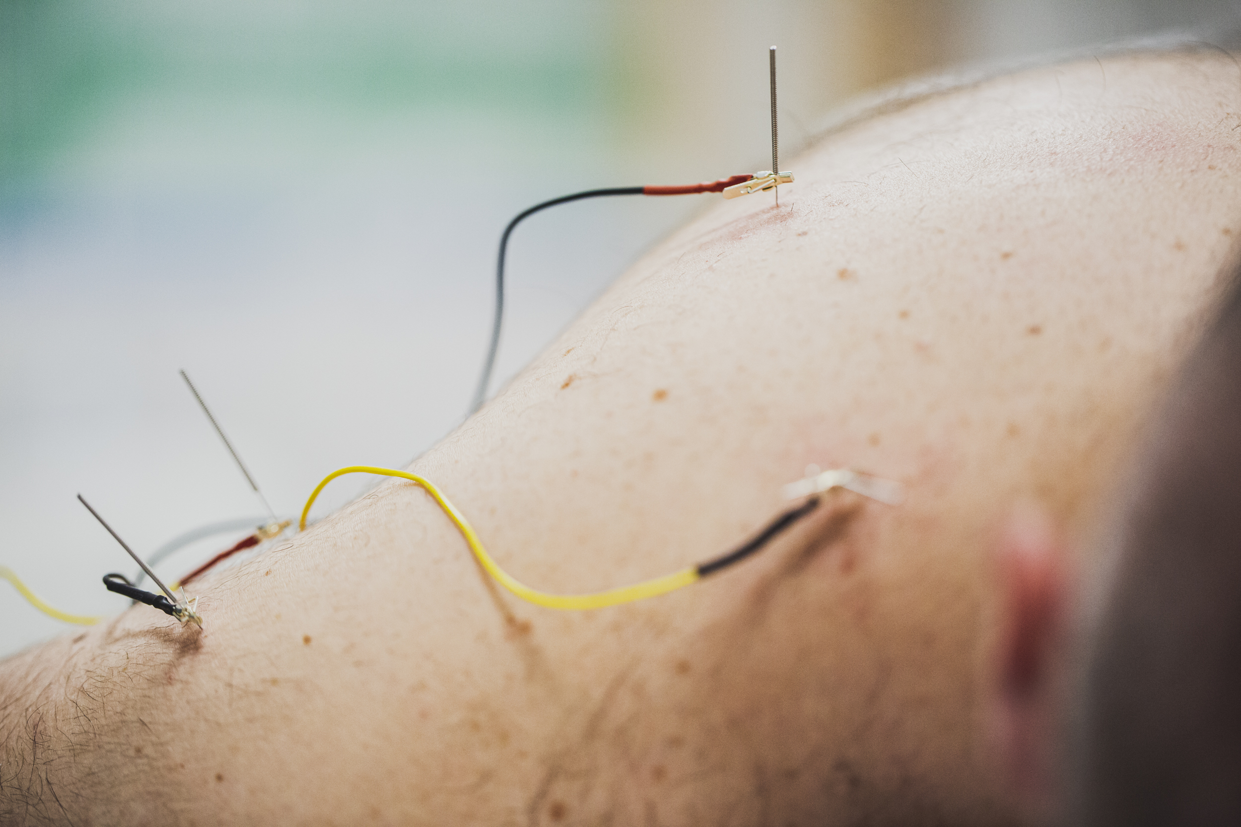 _MG_7209 Neuromodulación en la clínica Ayensa fisioterapia Zaragoza