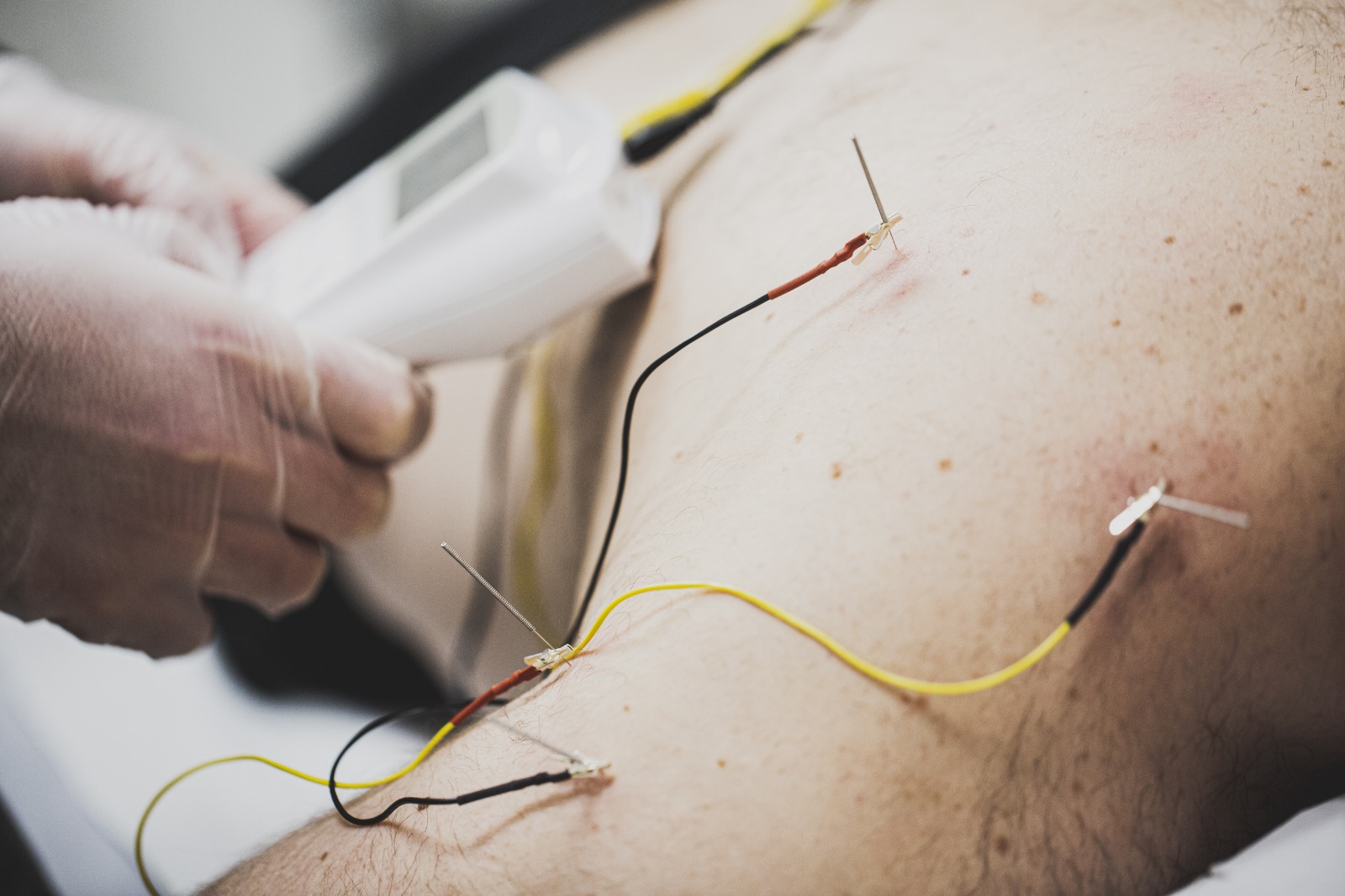 neuromodulacion-zaragoza-ayensa-fisio Fibrólisis diacutánea en Ayensa fisioterapia Zaragoza